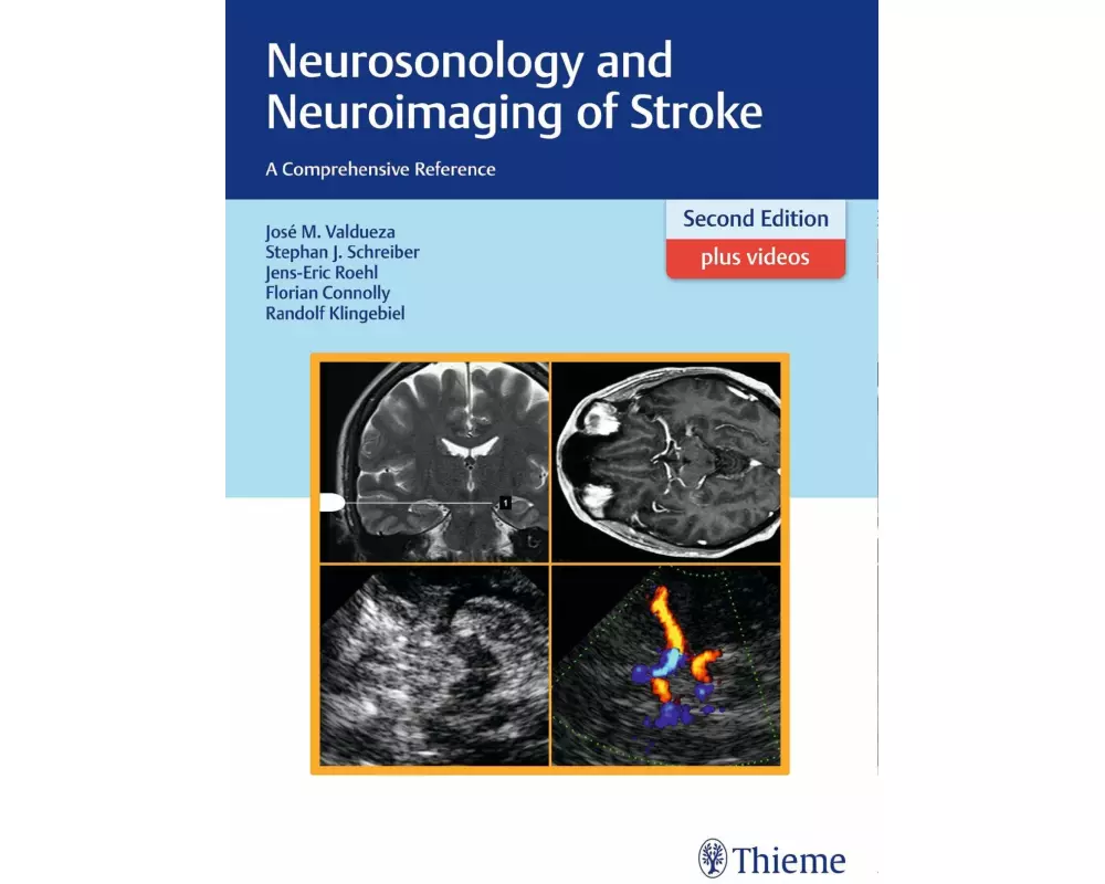 Neurosonology and Neuroimaging of Stroke