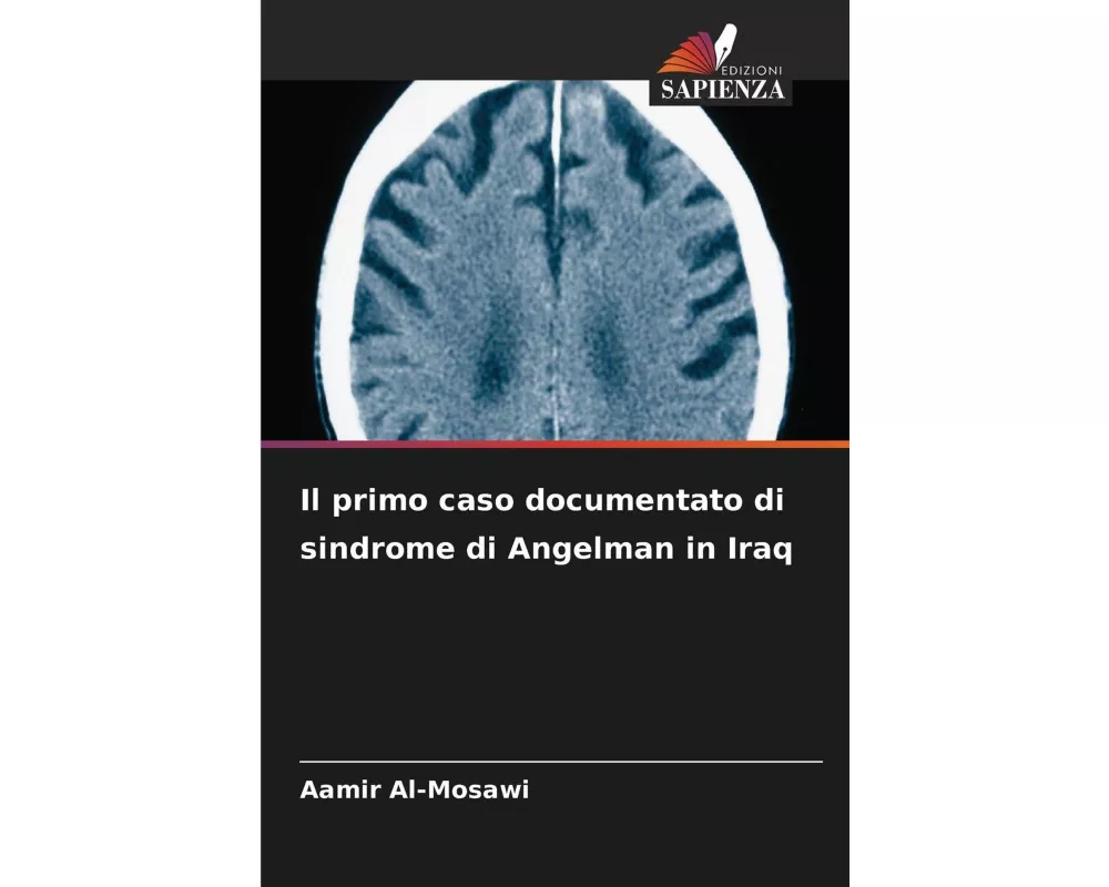 Il primo caso documentato di sindrome di Angelman in Iraq