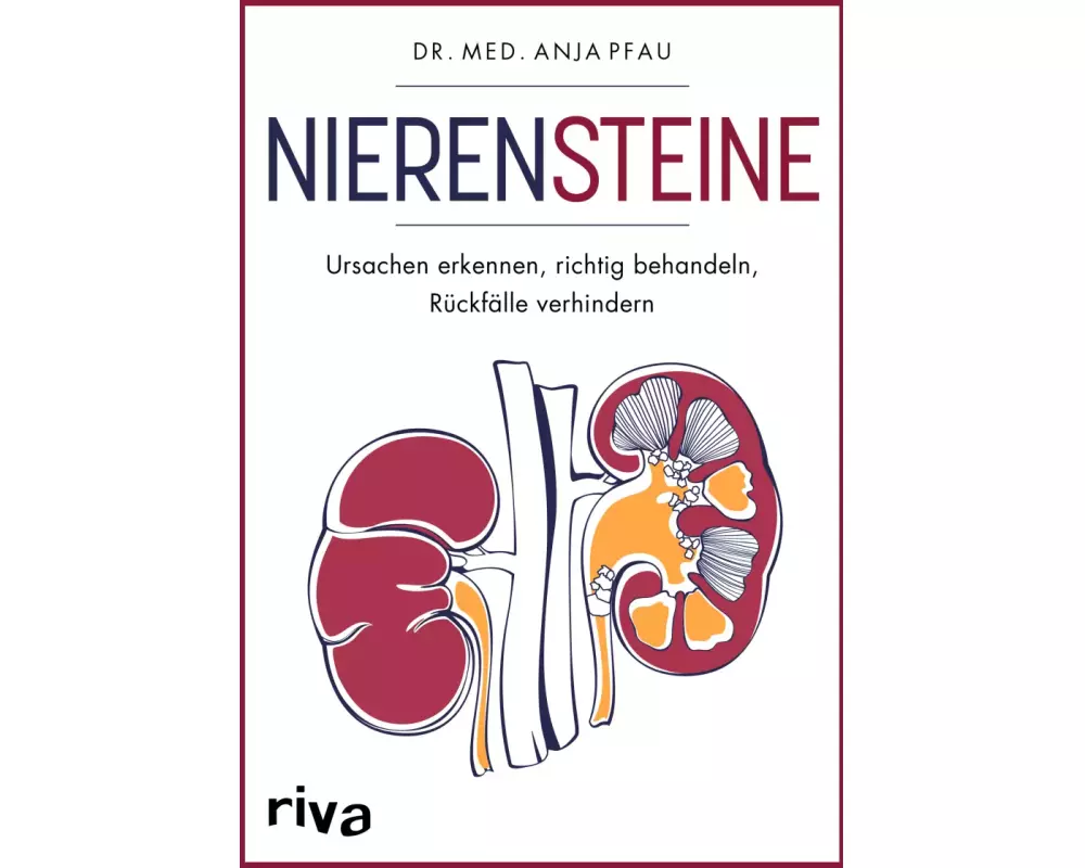 Nierensteine – Ursachen erkennen, richtig behandeln, Rückfälle verhindern