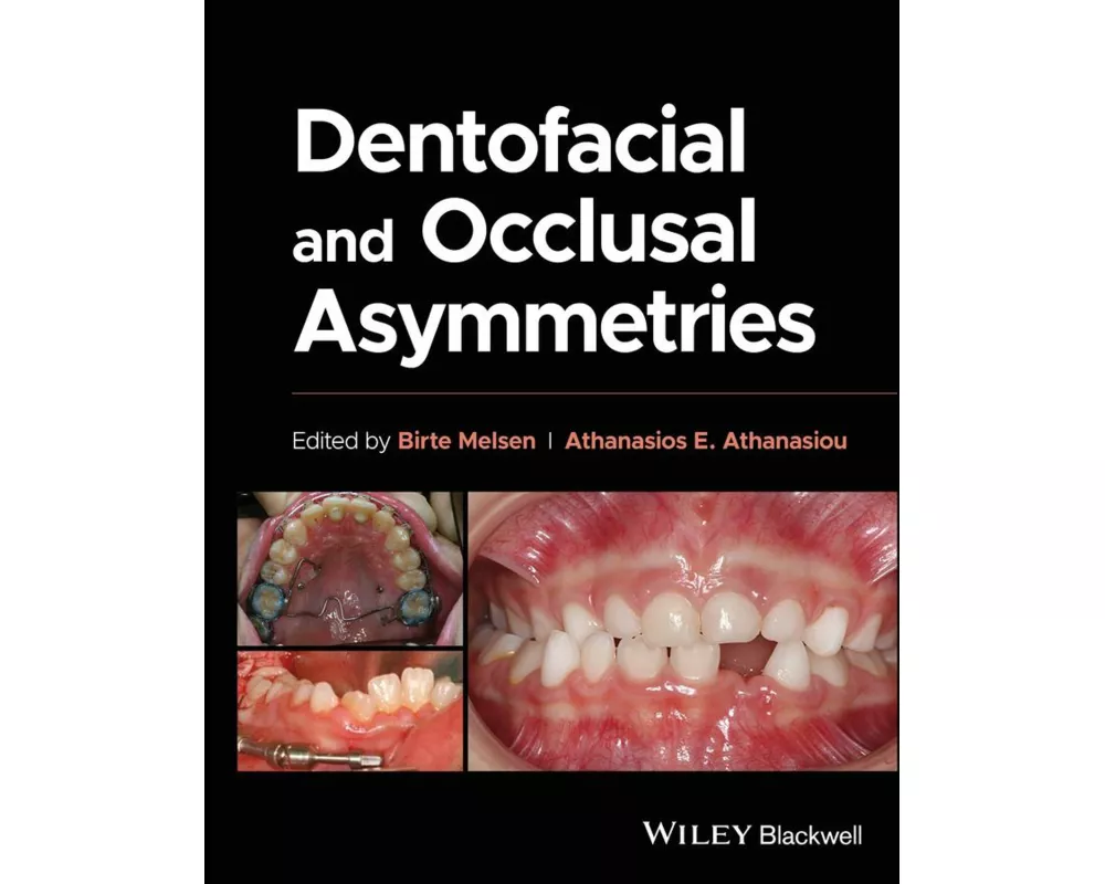 Dentofacial and Occlusal Asymmetries