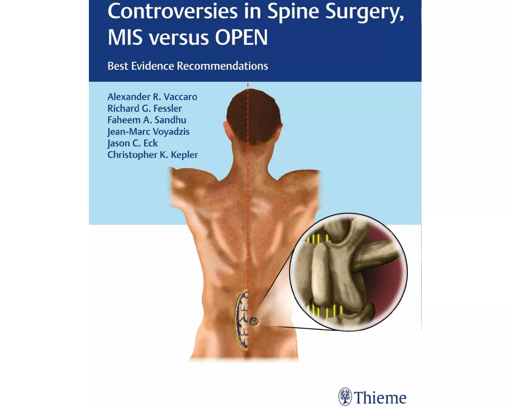 Controversies in Spine Surgery, MIS versus Open