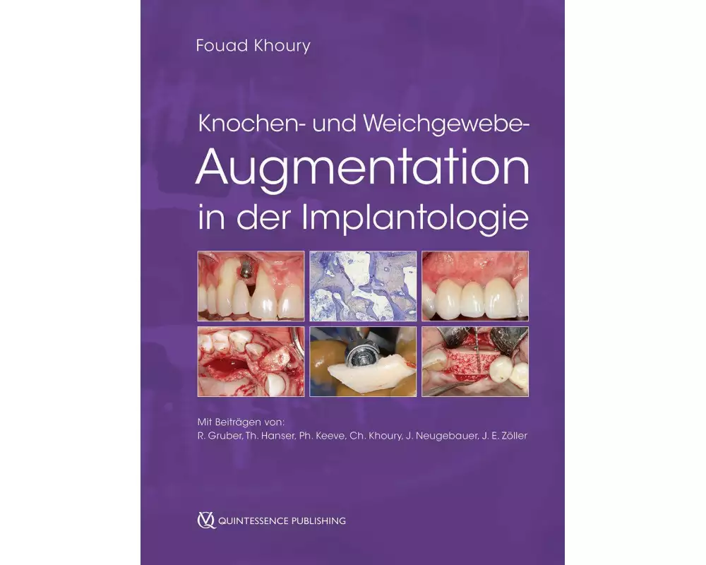 Knochen- und Weichgewebeaugmentation in der Implantologie