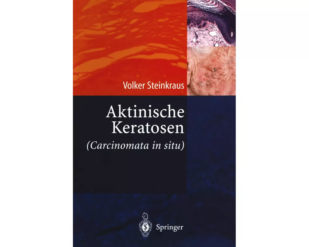Aktinische Keratosen (Carcinomata in situ)