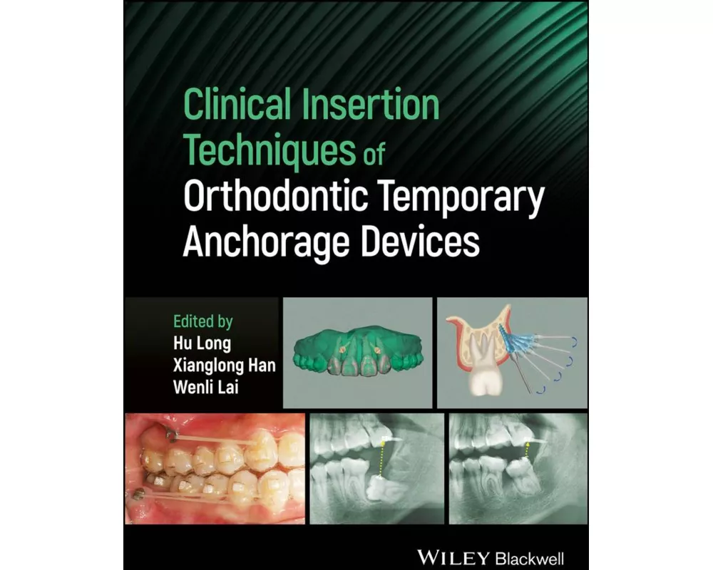 Clinical Insertion Techniques of Orthodontic Temporary Anchorage Devices