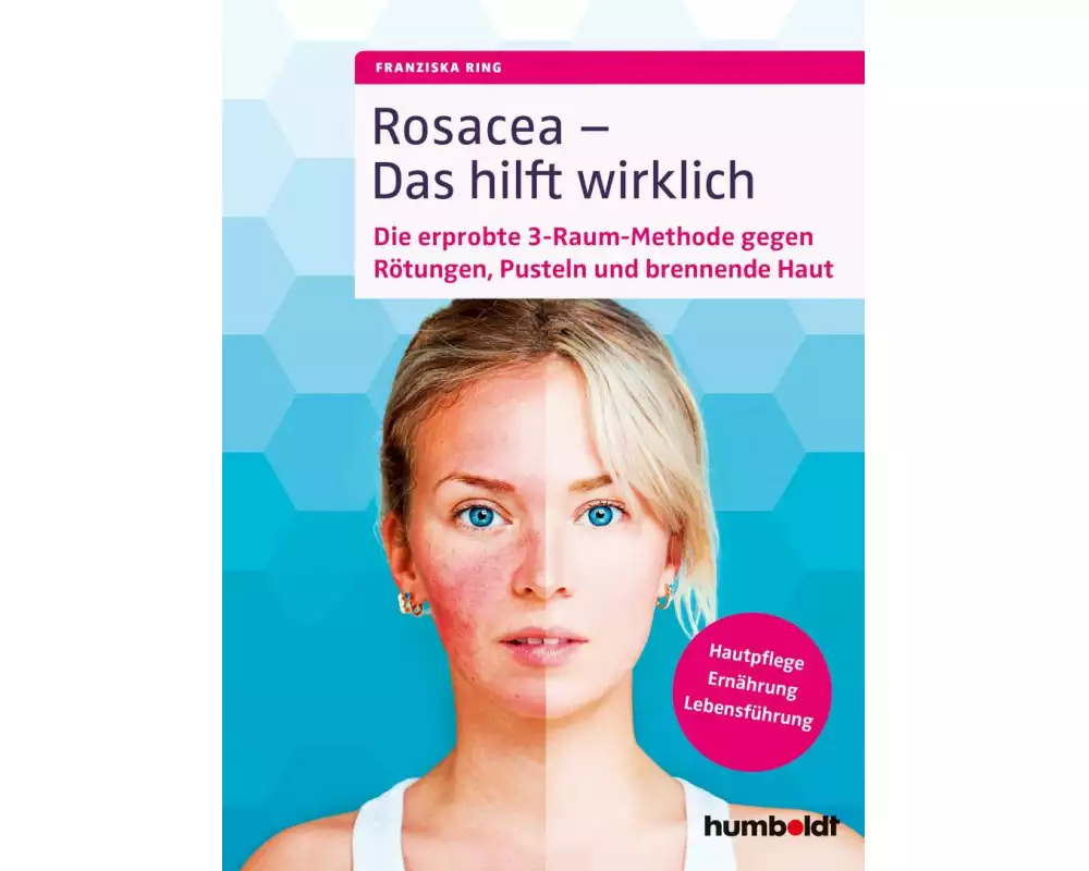 Rosacea – Das hilft wirklich